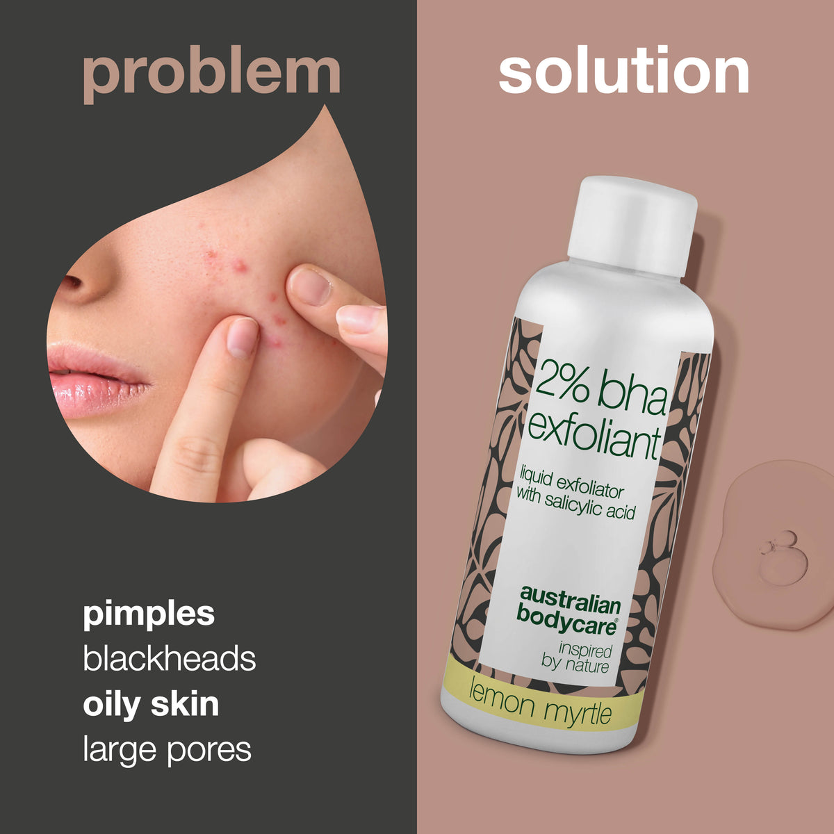 Bunky Zone Exfoliačný Peeling s 2% BHA Kyselinou Salicylovou – Menej mazu a ...