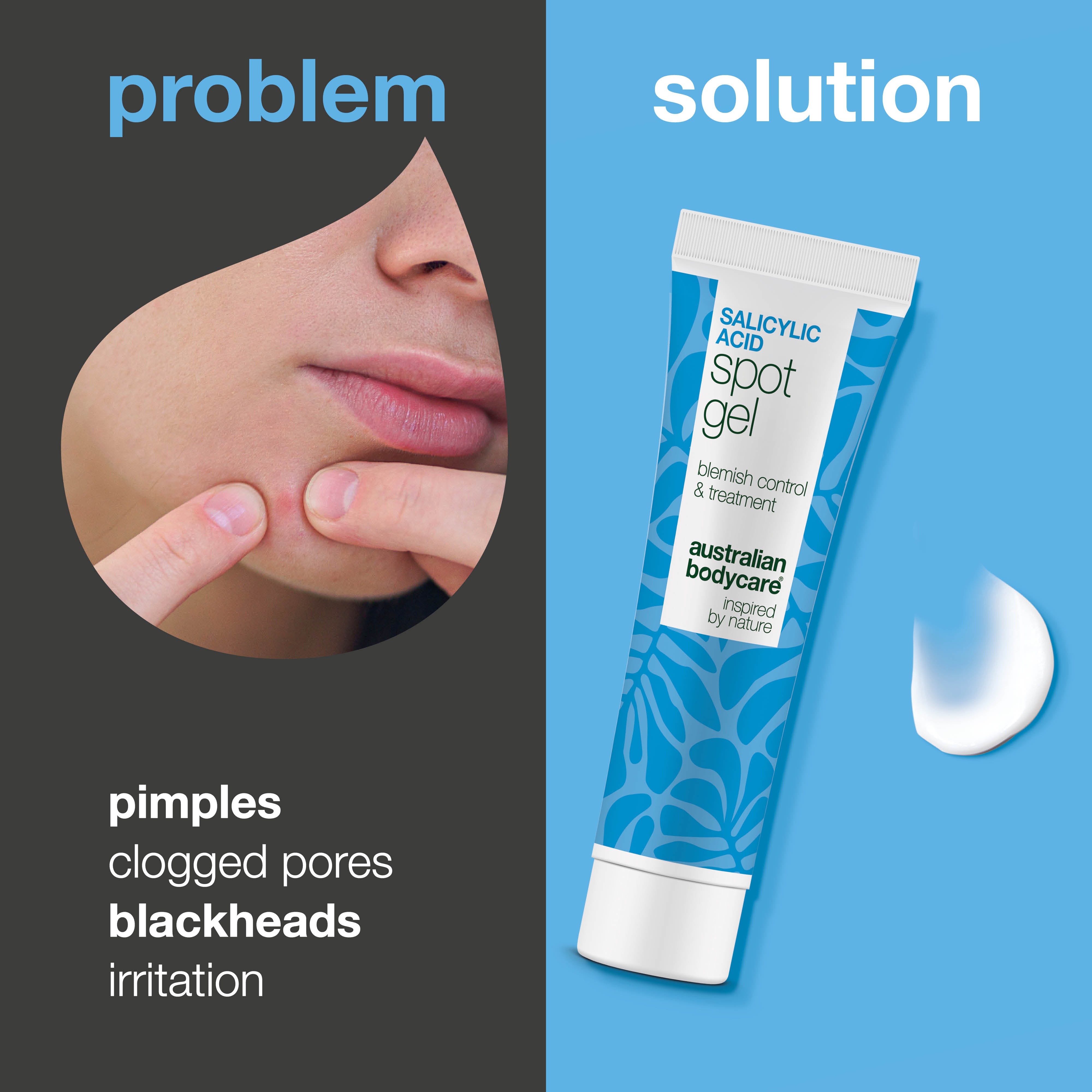 Spot gél s kyselinou salicylovou na akné, čierne bodky a začervenanie – čistí póry a upokojuje pokožku