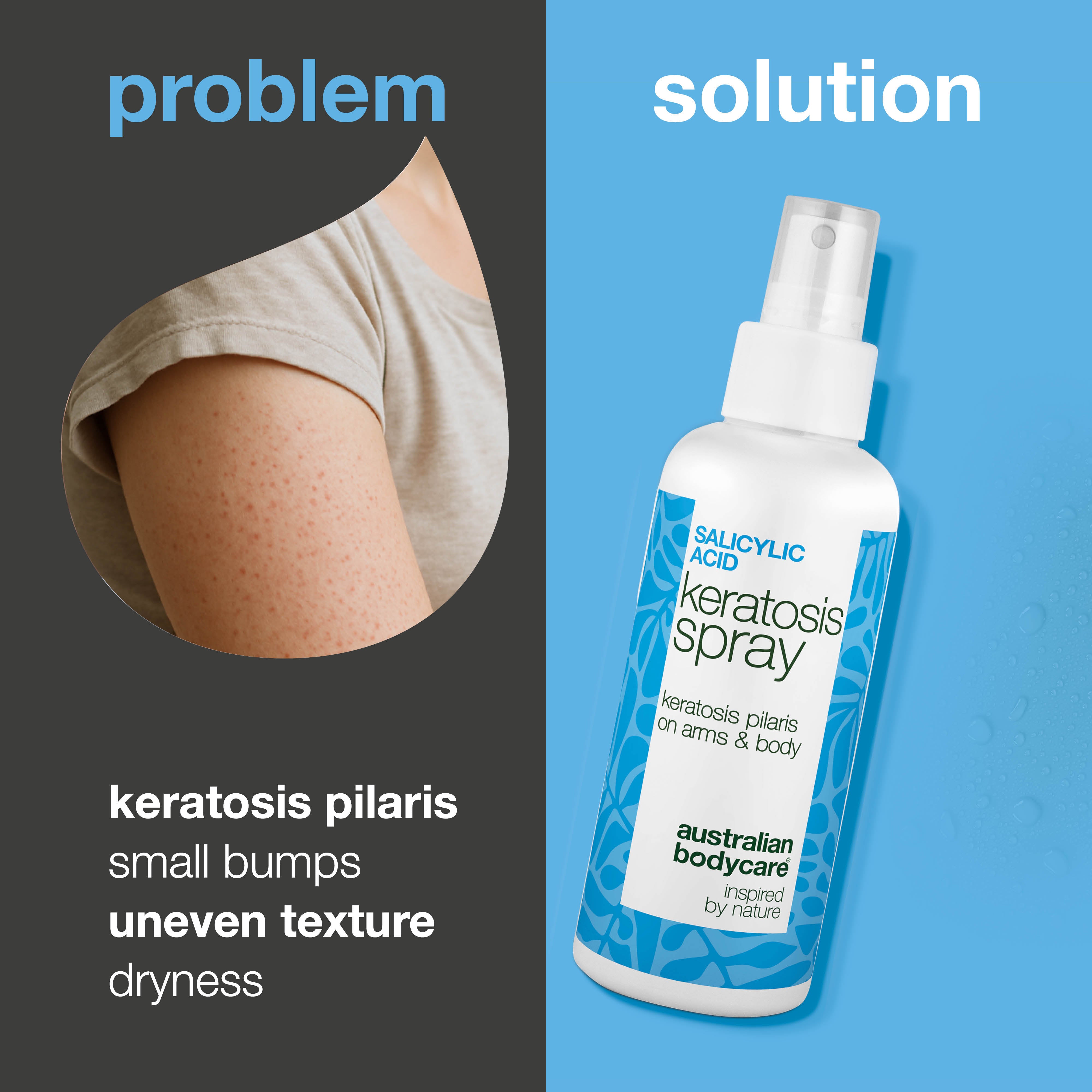 Sprej na keratosis pilaris a hrubú, drsnú pokožku — Keratosis pilaris sprej zmierňuje drsnú kožu a hrčky. Obsahuje kyselinu salicylovú na jemné čistenie a vyhladenie pokožky.