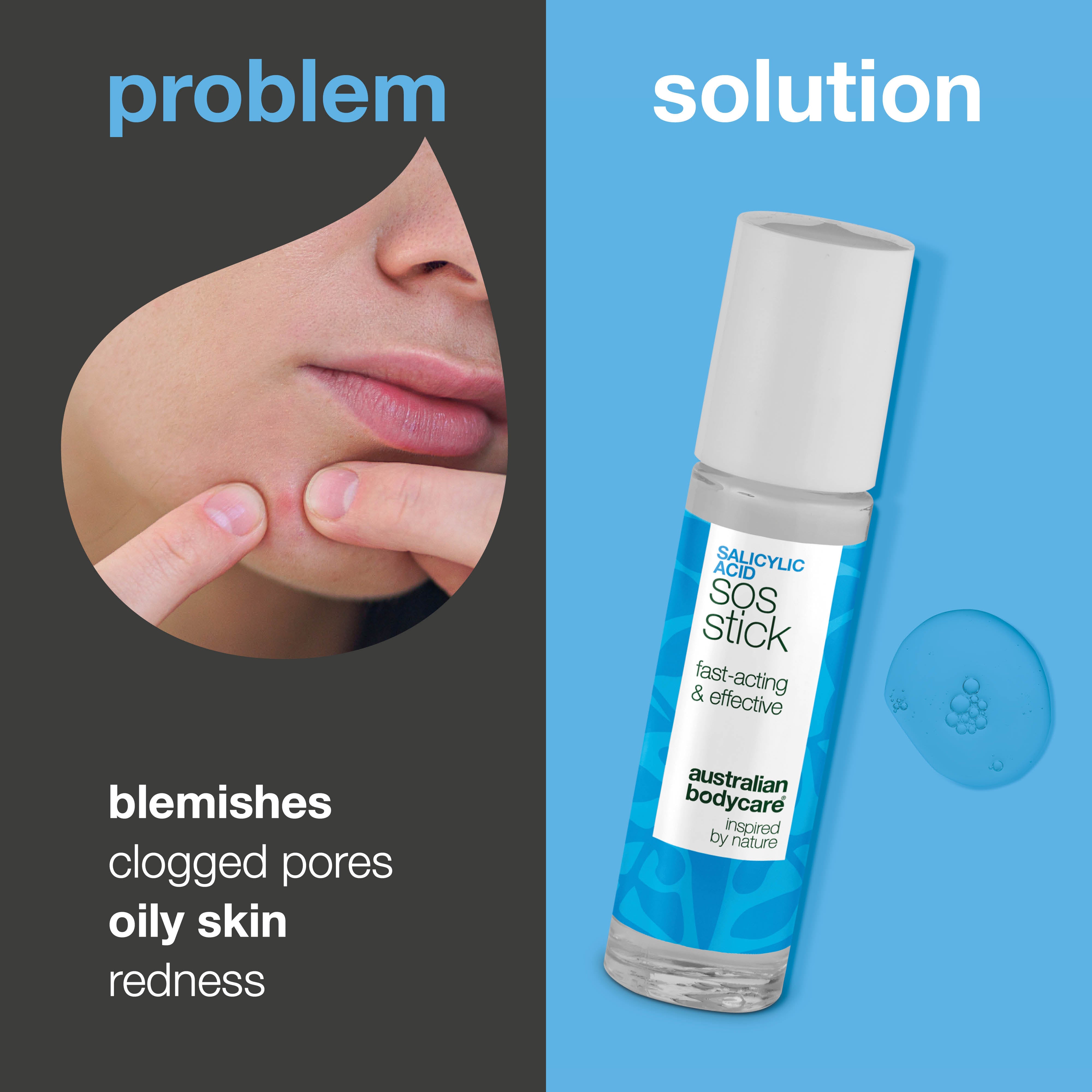 SOS tyčinka s kyselinou salicylovou – zmierňuje začervenanie, čistí póry a redukuje akné