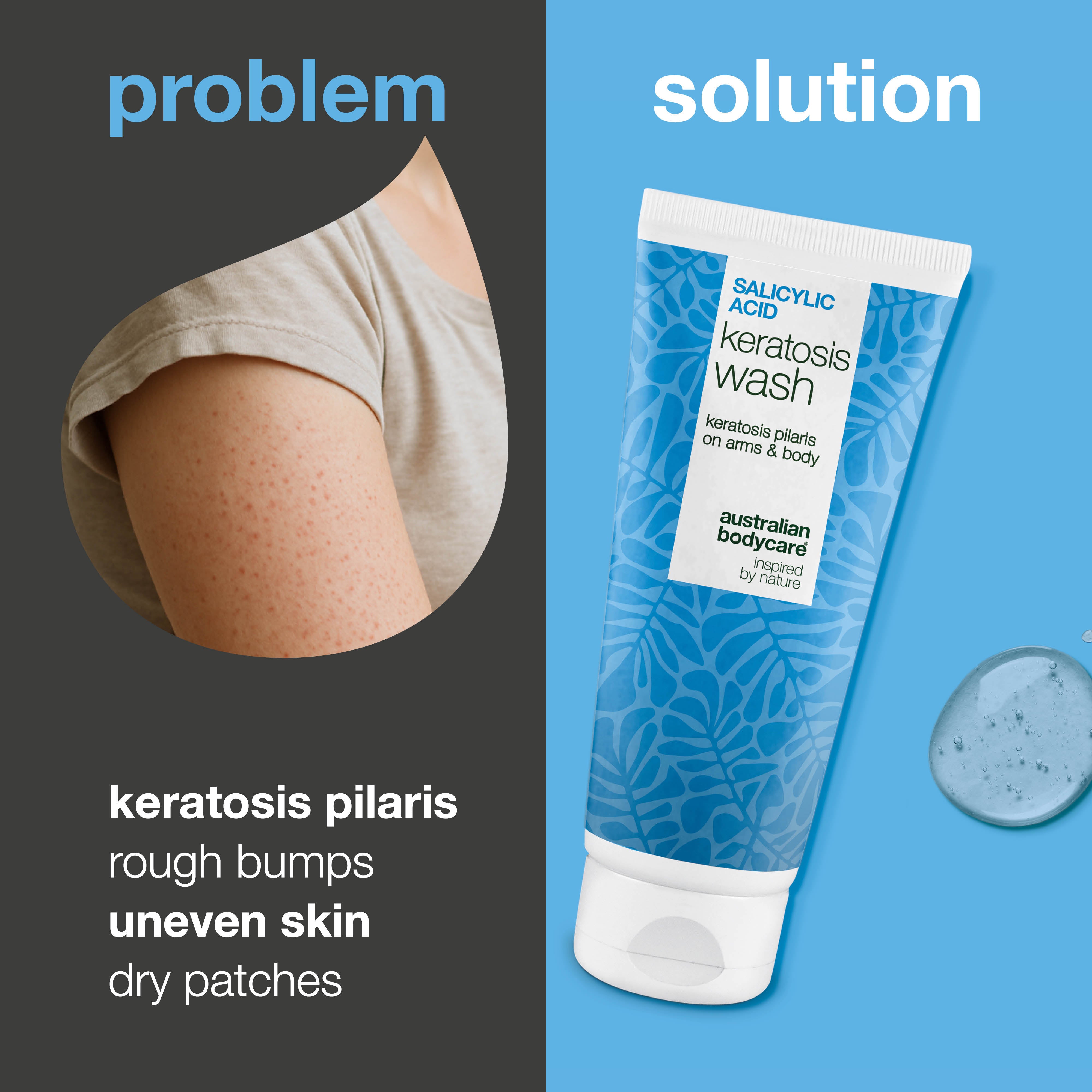 Keratosis Pilaris Sprchový gél na keratózu pilaris, upchaté póry a začervenanie. S kyselinou salicylovou, niacínamidom, zinkom PCA a vitamínom E pre výsledky.