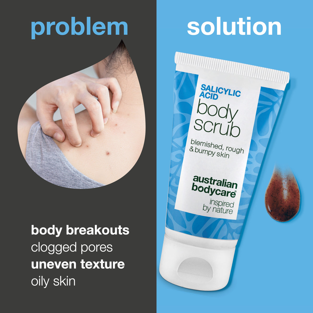Problém a riešenie: pupienky na tele, upchaté póry a nerovná pokožka. Vľavo detail ramena s pupienkami, vpravo Salicylic Acid Body Scrub od Australian Bodycare