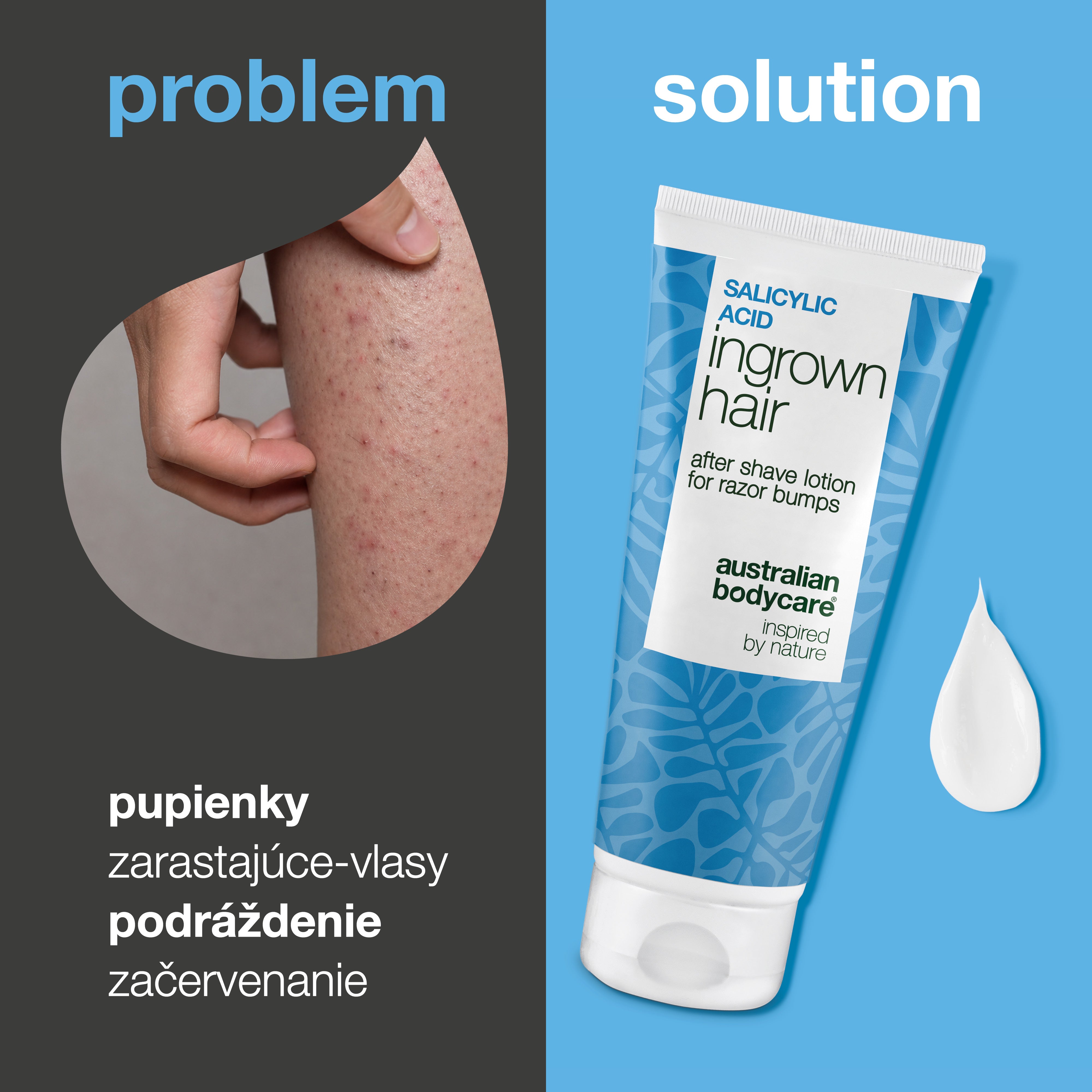 Mlieko po holení s kyselinou salicylovou na zarastajúce chĺpky, červené vyrážky a podráždenie po holení. Produkt je zobrazený vedľa pokožky s viditeľnými červenými vyrážkami a zarastajúcimi chĺpkami.