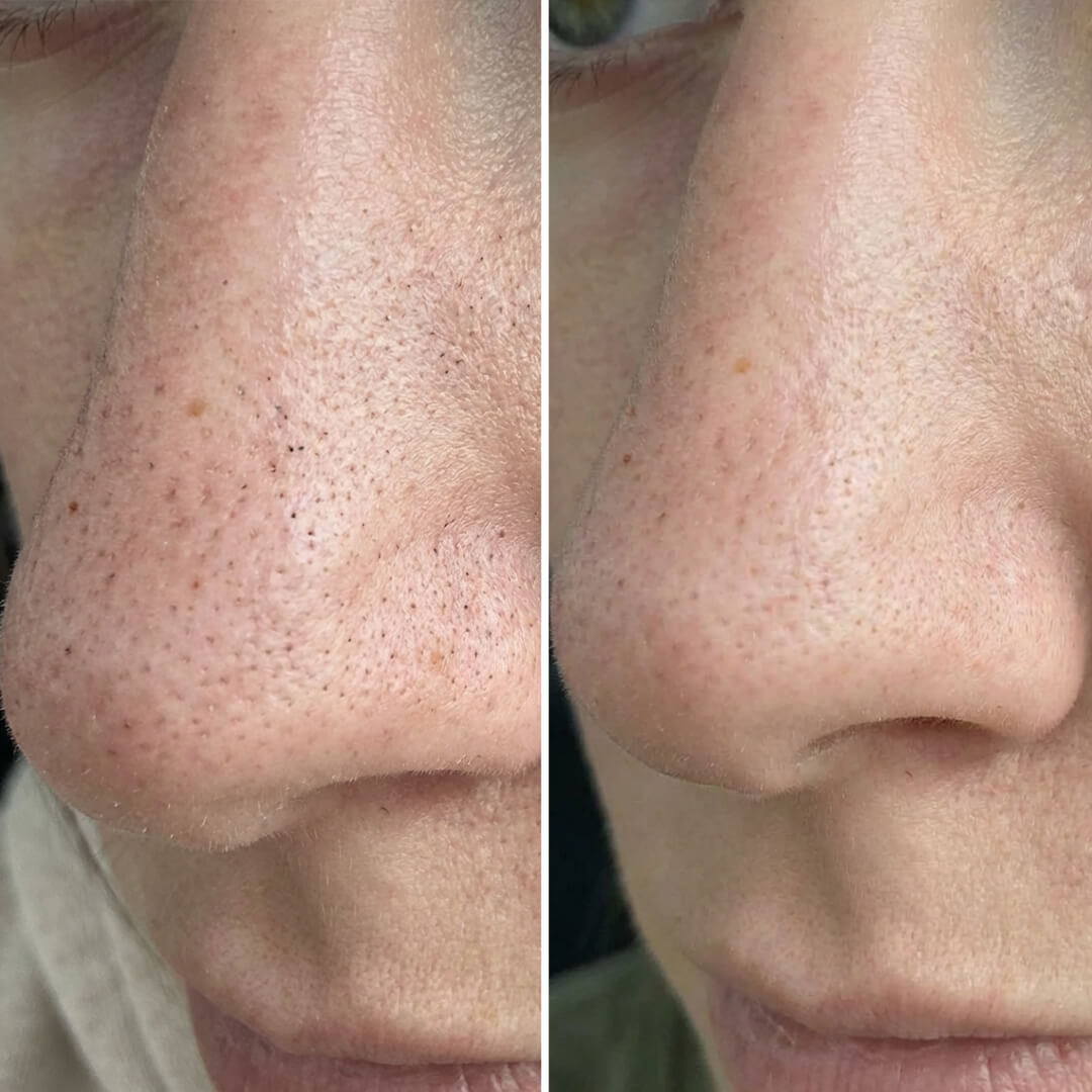 Balíček proti čiernym bodkám a upchatým pórom s kyselinou salicylovou – hĺbkové čistenie pleti