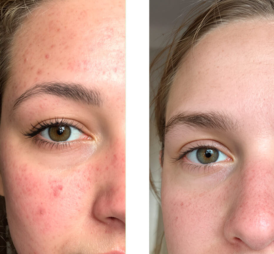Fotografia pred a po zákazníka používajúceho naše 2% Salicylic Acid Face Toner/Peeling/Exfoliant, ukazujúca veľké zlepšenie pleti s menej vyrážkami a nedokonalosťami.