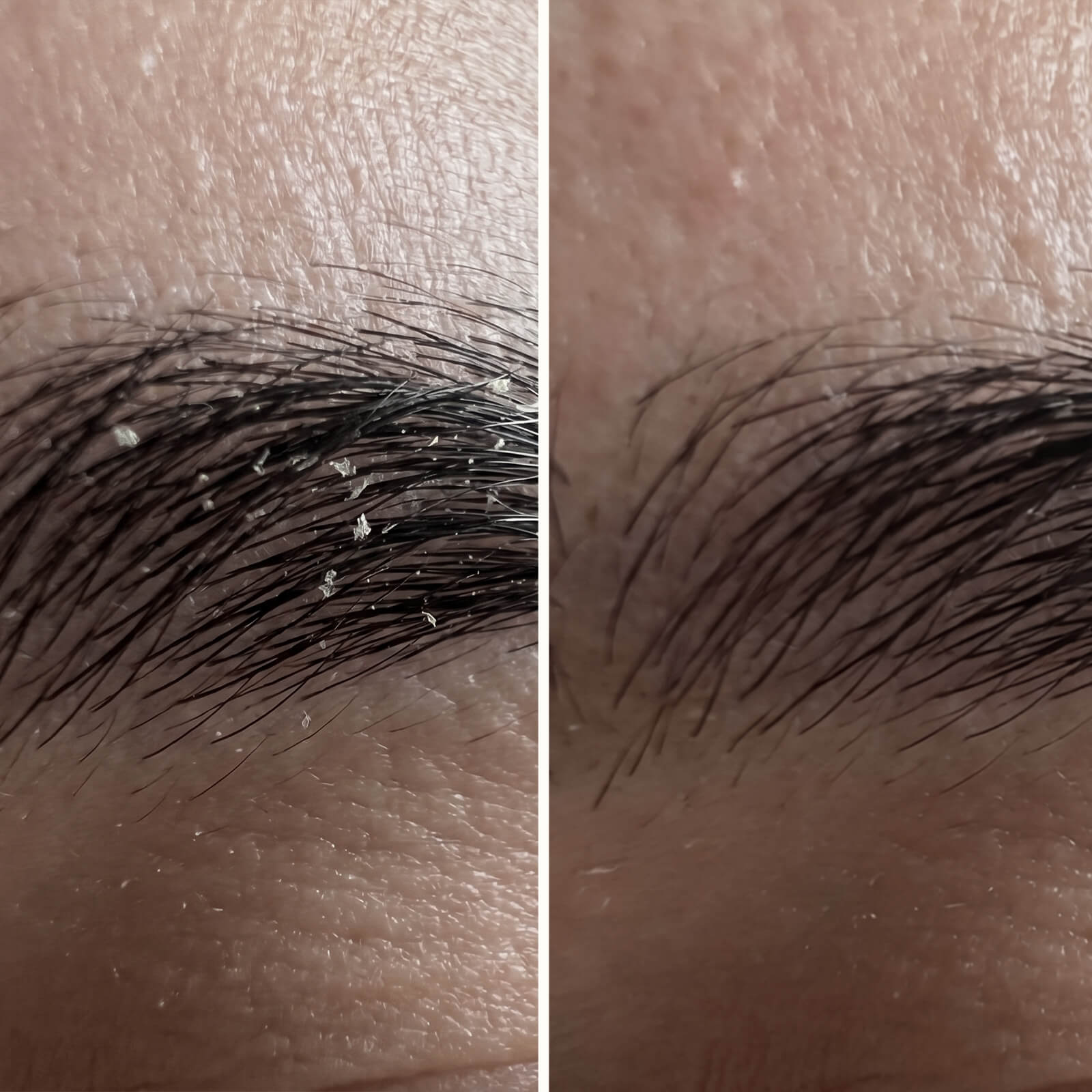 Sérum s kyselinou salicylovou – Na lupiny v tvári a brade — Účinné sérum na lupiny v tvári a brade. Kyselina salicylová rýchlo odstraňuje šupinky a začervenanie pre zdravú rovnováhu pleti.