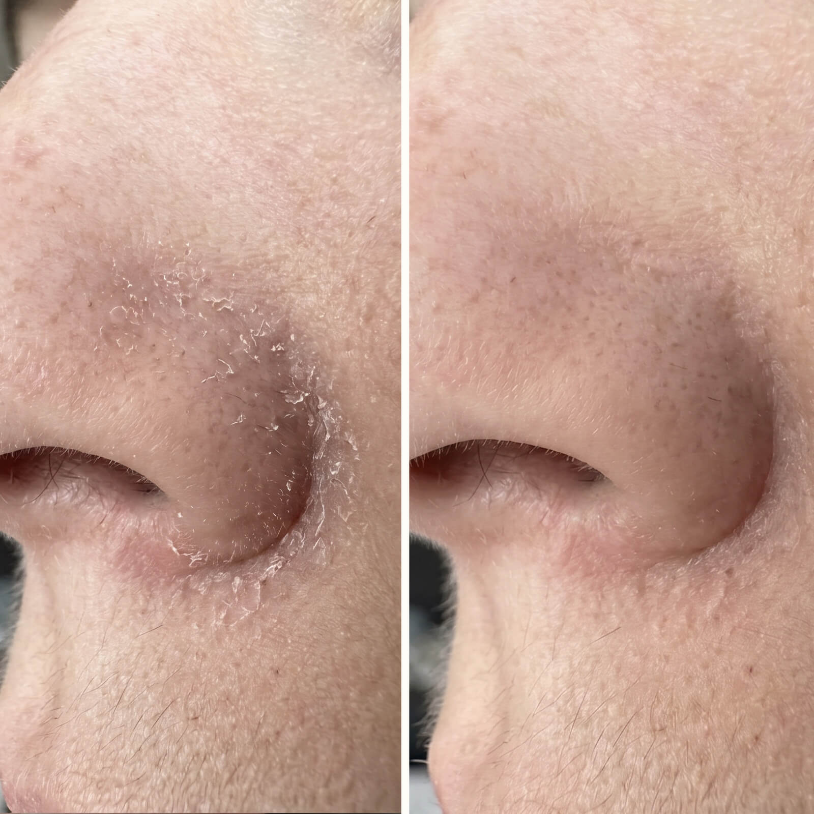 Sérum s kyselinou salicylovou – Na lupiny v tvári a brade — Účinné sérum na lupiny v tvári a brade. Kyselina salicylová rýchlo odstraňuje šupinky a začervenanie pre zdravú rovnováhu pleti.