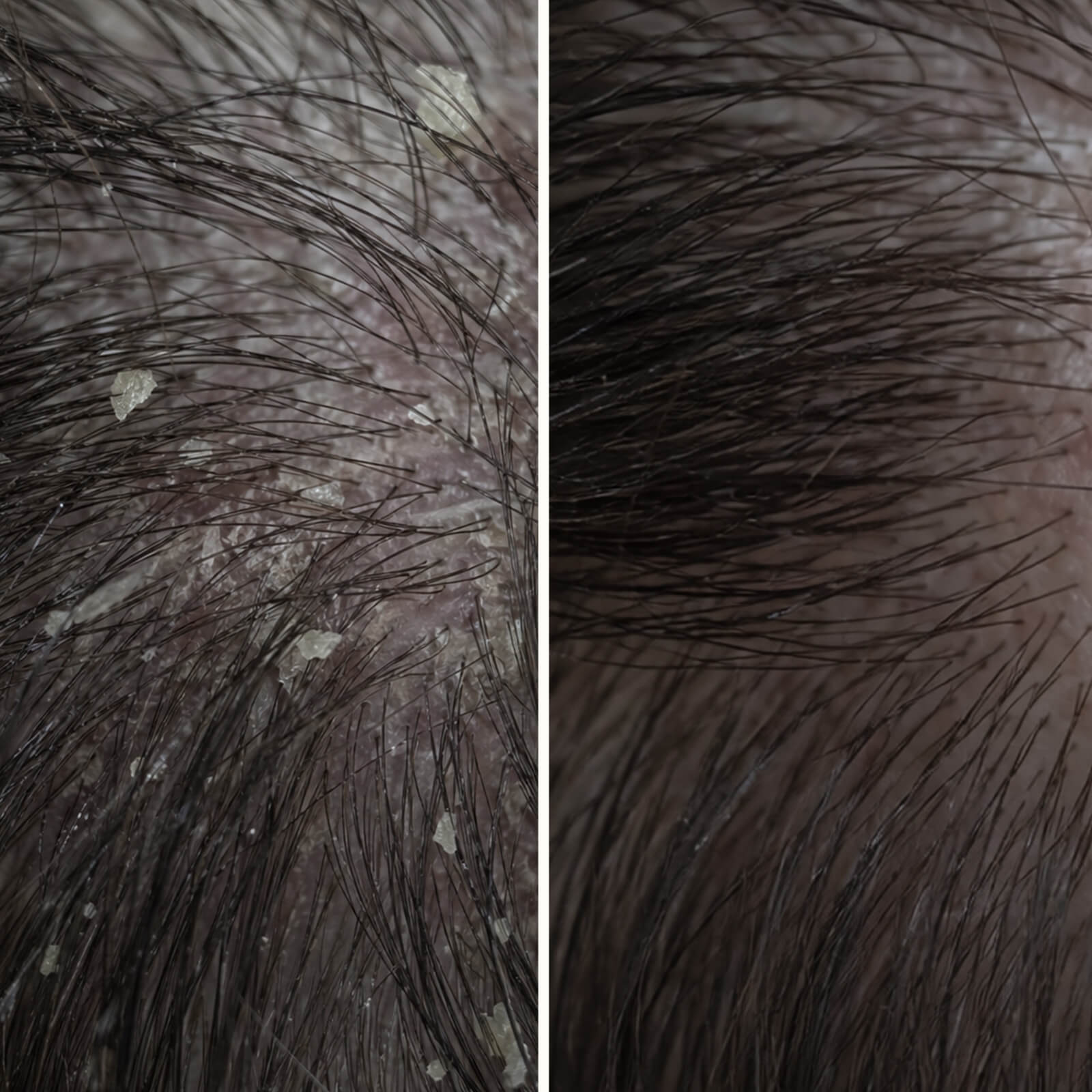 Kúra na pokožku hlavy s kyselinou salicylovou na lupiny, svrbenie a mastnotu — Kúra s kyselinou salicylovou pre šupinatú a svrbivú pokožku hlavy. Jemne exfoliuje a nastoľuje rovnováhu pred umývaním.