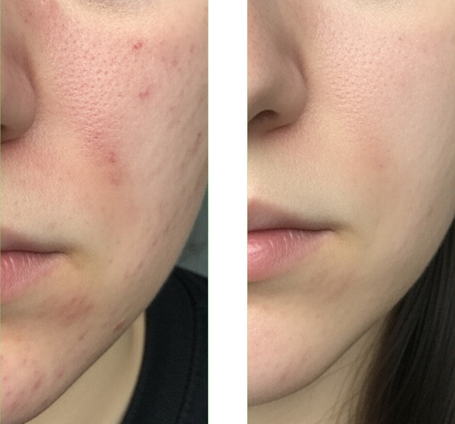 Fotografia pred a po zákazníka používajúceho náš Salicylic Acid Cleanser, ukazujúca veľké zlepšenie pleti s menej vyrážkami a nedokonalosťami.