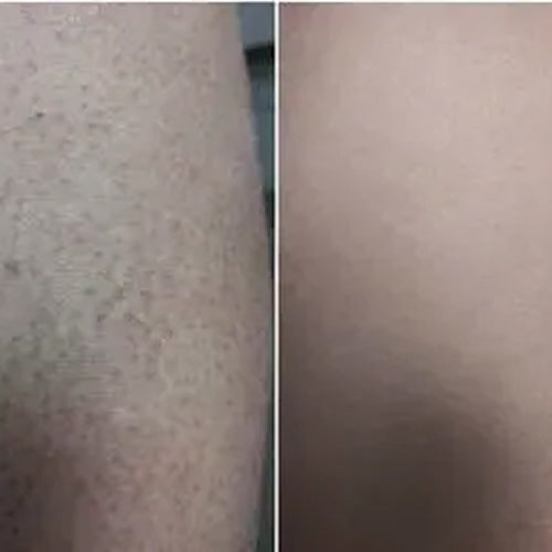 Výsledok Aleny po 2 týždňoch s liečebnou sadou keratosis pilaris