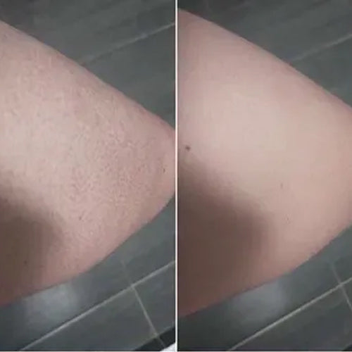 Keratosis pilaris pred a po – hladšia pokožka Aleny po 2 týždňoch