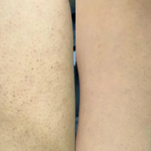 Výsledok Isabell s liečebnou sadou keratosis pilaris – menej pupienkov na stehnách