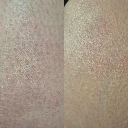 Detail pokožky po liečbe keratosis pilaris – výsledok Carolin