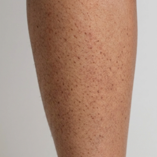 Detail keratosis pilaris – drobné drsné pupienky na ramenách