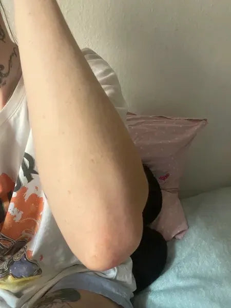 Výsledok zákazníka keratosis pilaris – Lisa A.