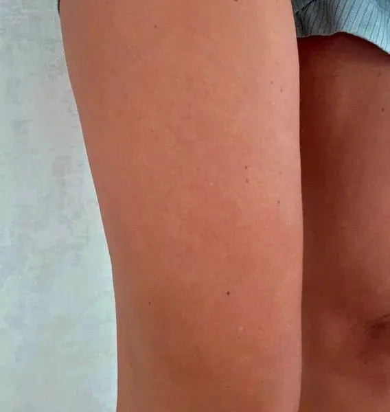 Výsledok zákazníka keratosis pilaris – Sarah S.