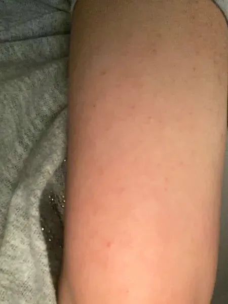 Výsledok zákazníka keratosis pilaris – Shaian H. používa Australian Bodycare