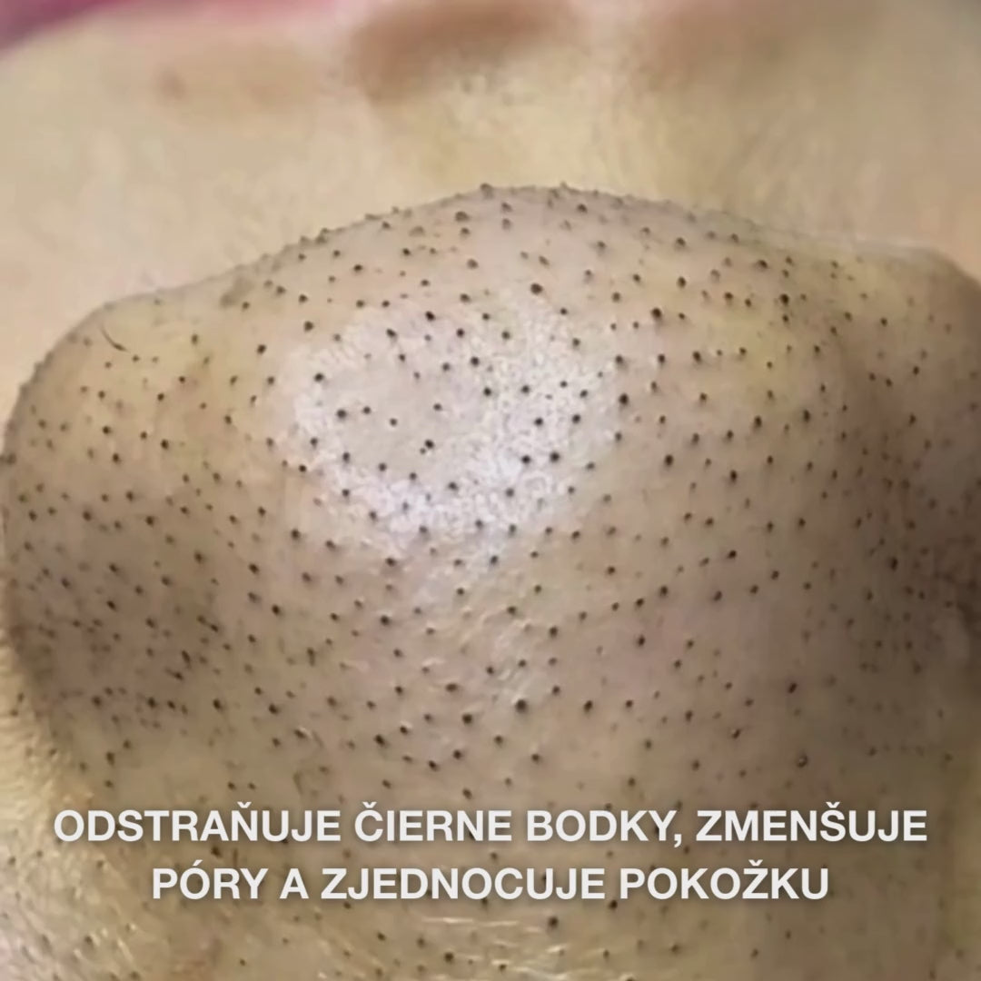 Salicylic Acid toner pomáha pri nedokonalostiach, čiernych bodkách a nerovnej pokožke. Účinná starostlivosť so Salicylic Acid od Australian Bodycare.