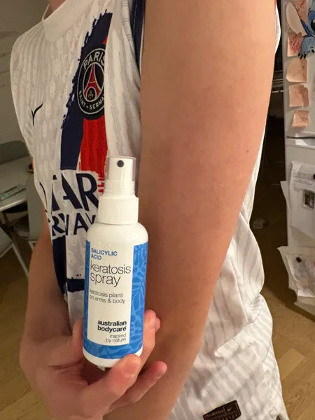 Výsledok zákazníka keratosis pilaris – 70% menej pupienkov po 3 týždňoch